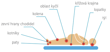 Grafika ležící postavy s popisem míst častého vzniku dekubitů